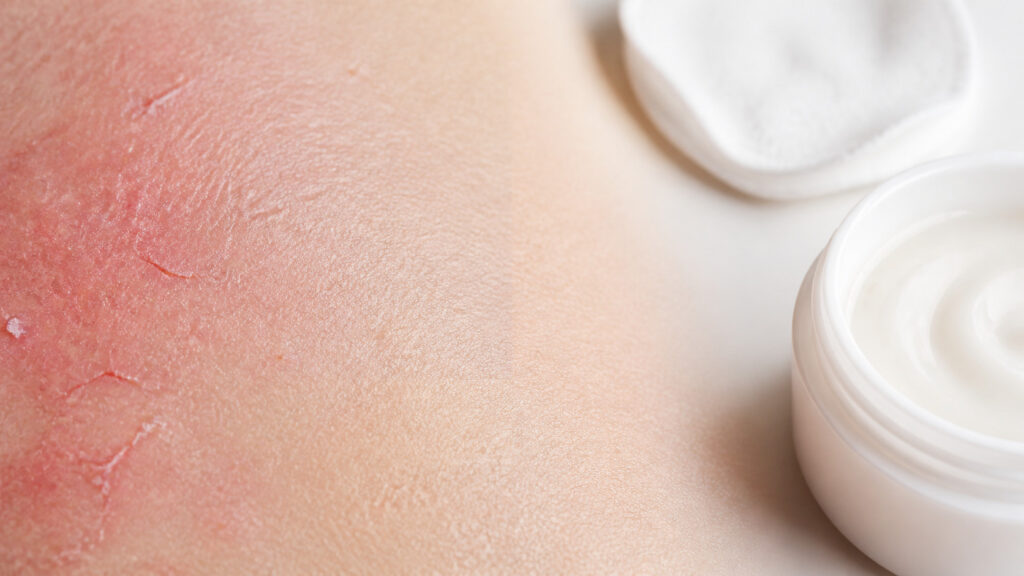 Peau irritée : causes, signes et solutions pour l’apaiser