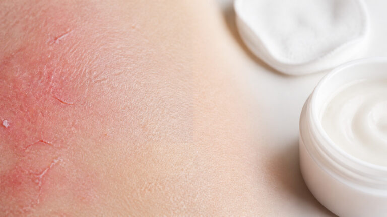 Peau irritée : causes, signes et solutions pour l’apaiser